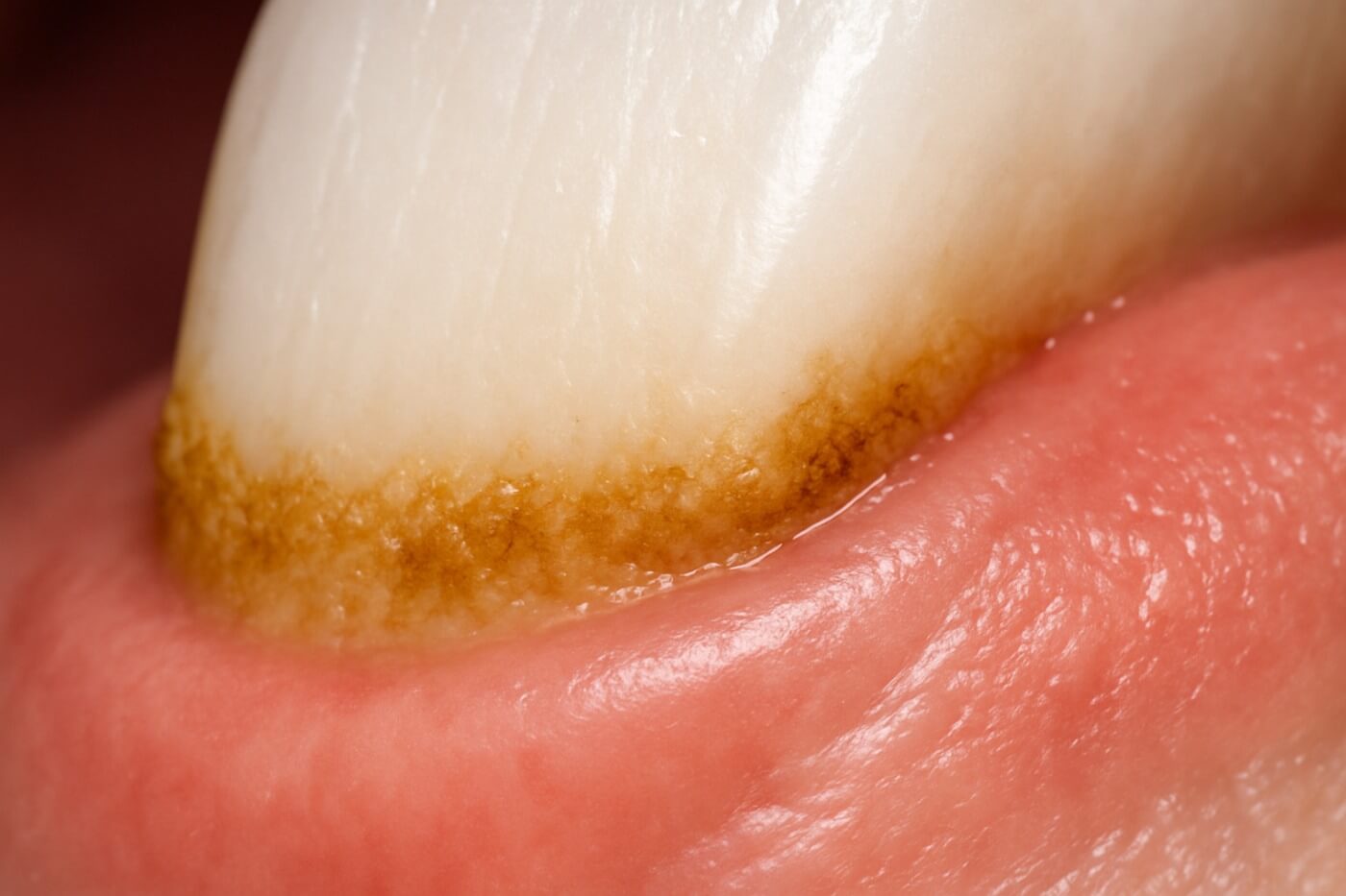 Зубной камень на эмали Макро-снимок зубного камня у десны